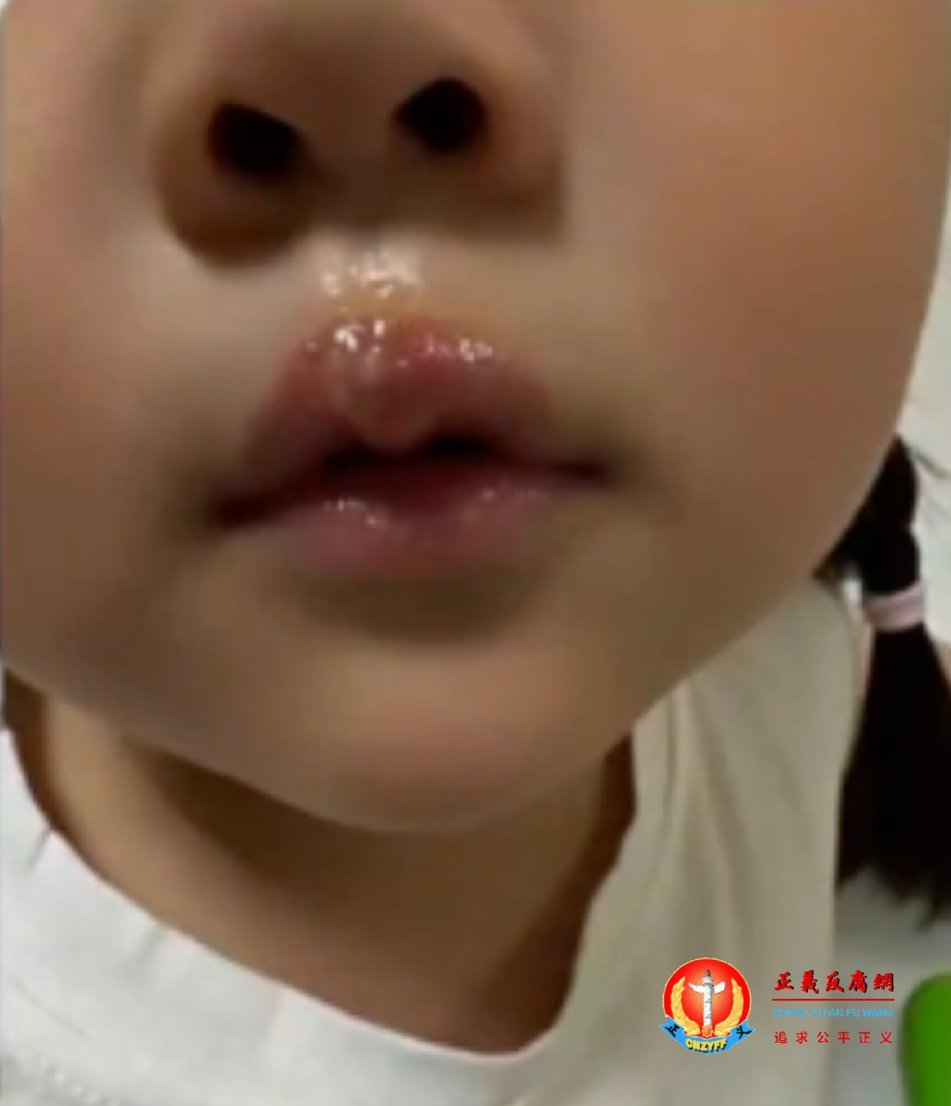 江苏徐州丰县一名幼儿被老师用热熔胶故意烫伤嘴唇，并遭到虐待体罚。.jpg